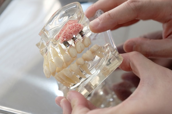 Reasons For Bone Grafting Before Dental Implants