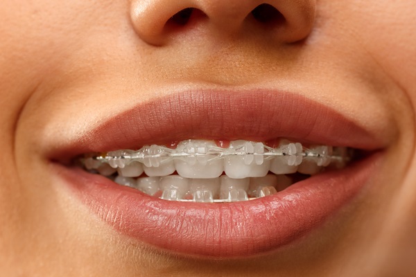 How To Keep Clear Braces From Yellowing